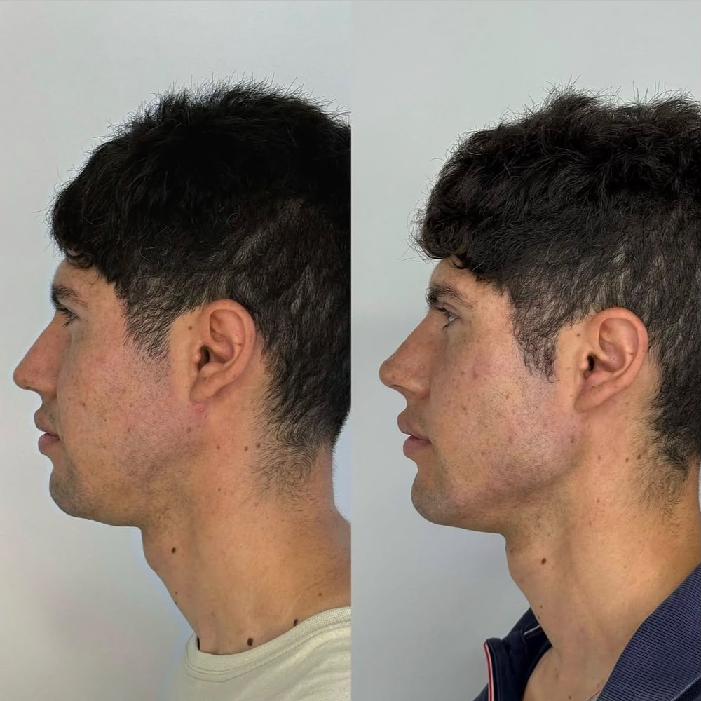 Armonización facial &mdash; antes y despu&eacute;s, vista perfil