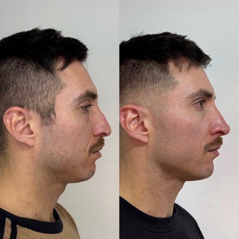 Armonización facial &mdash; antes y despu&eacute;s, vista perfil