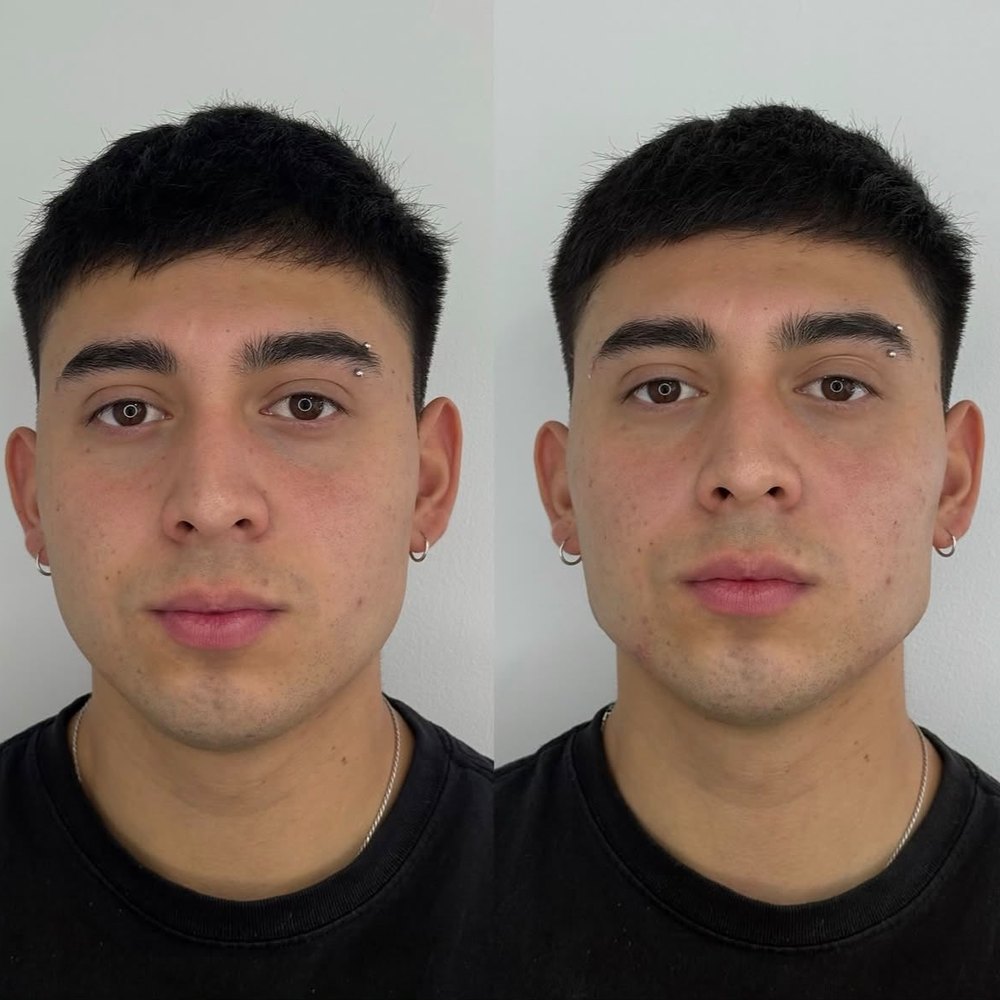 Armonización facial &mdash; antes y despu&eacute;s, vista frontal