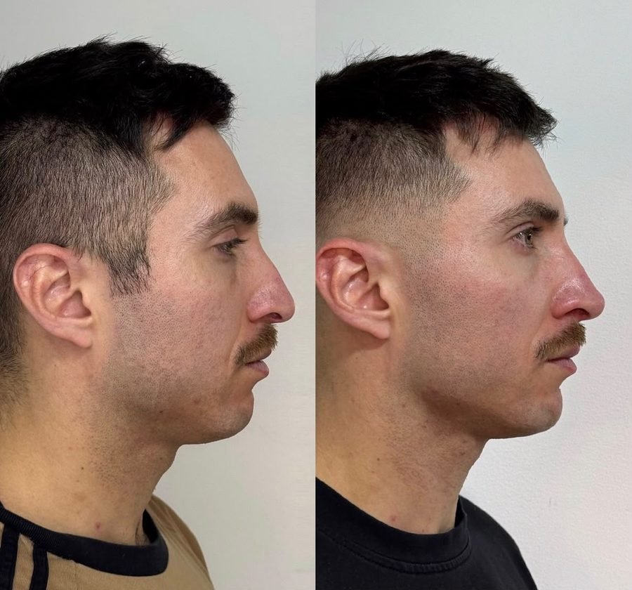 Perfilado mandibular &mdash; antes y despu&eacute;s, vista perfil