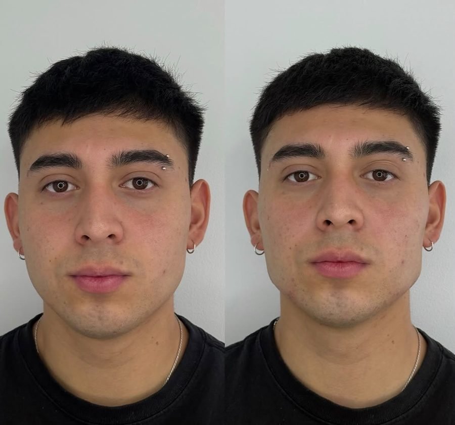 Perfilado mandibular &mdash; antes y despu&eacute;s, vista frontal