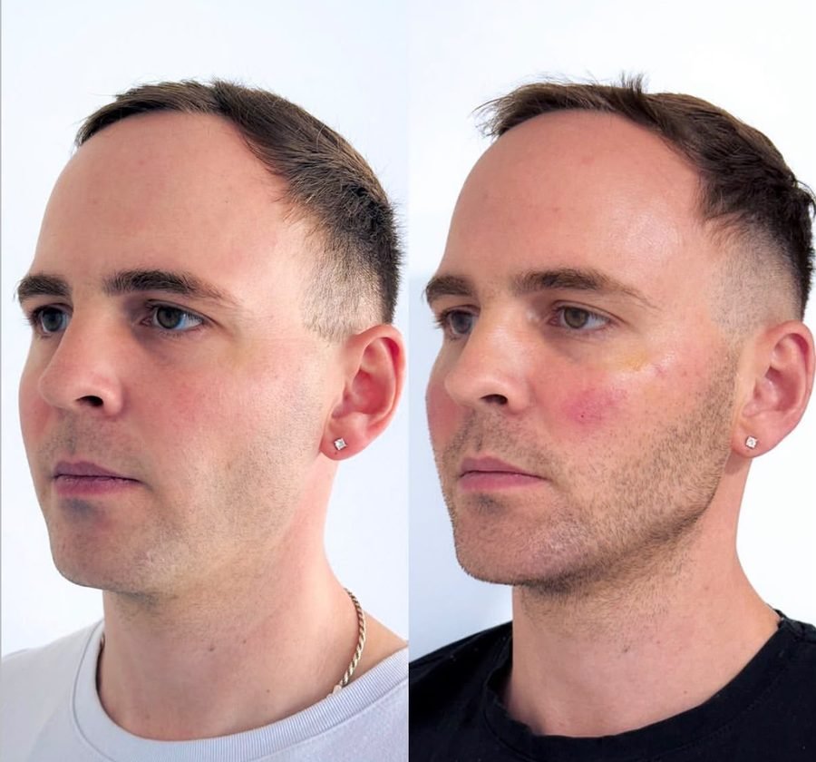 Perfilado mandibular &mdash; antes y despu&eacute;s, vista perfil
