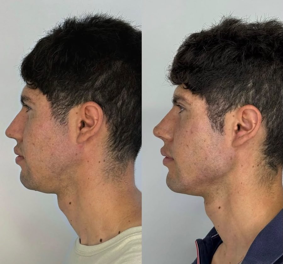 Perfilado mandibular &mdash; antes y despu&eacute;s, vista perfil