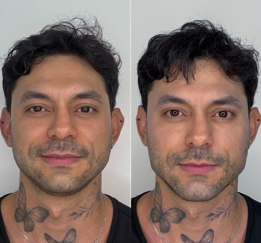 Perfilado mandibular &mdash; antes y despu&eacute;s, vista frontal