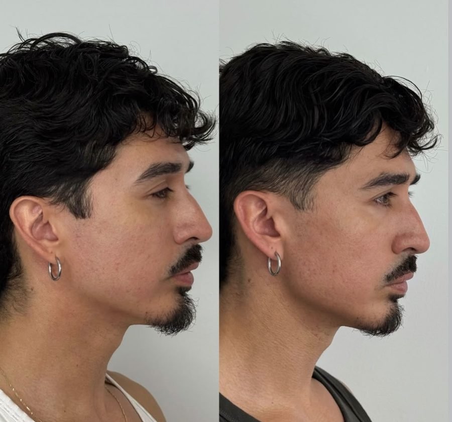Perfilado mandibular &mdash; antes y despu&eacute;s, vista perfil