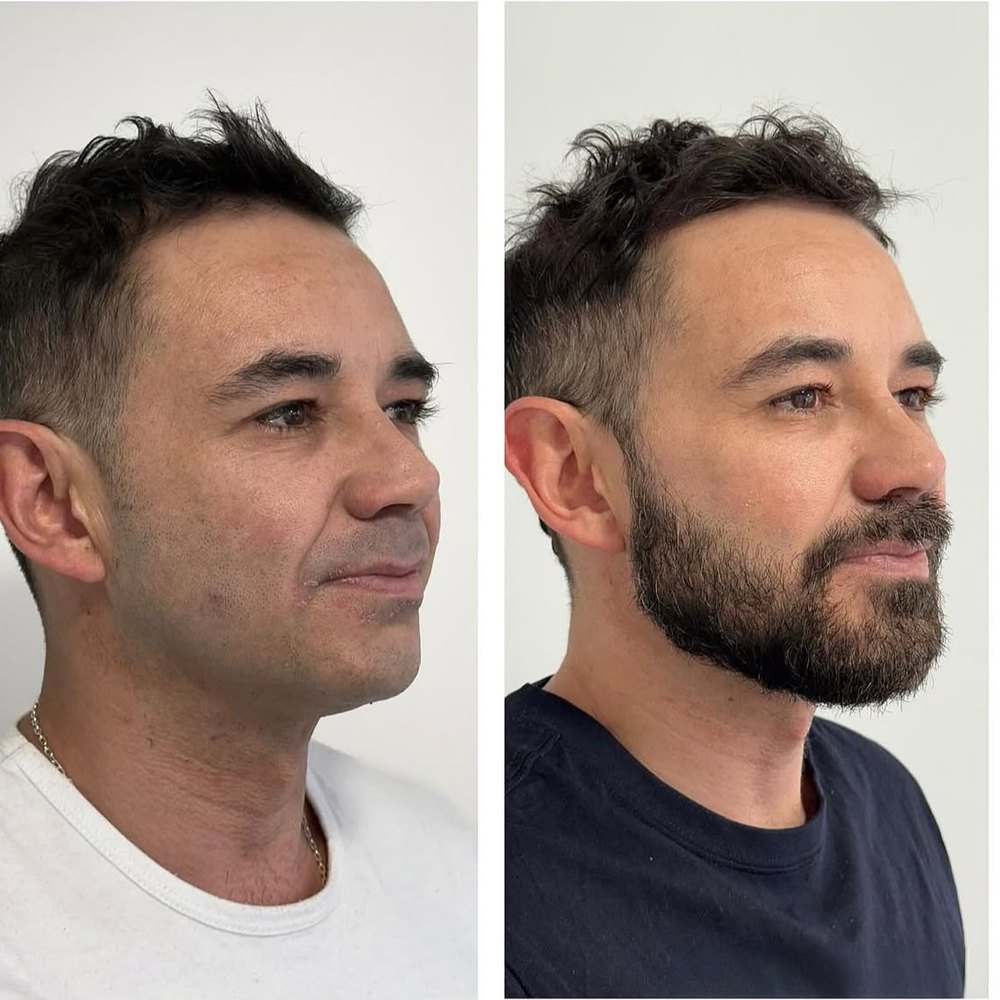 Rejuvenecimiento facial &mdash; antes y despu&eacute;s, vista tres cuartos